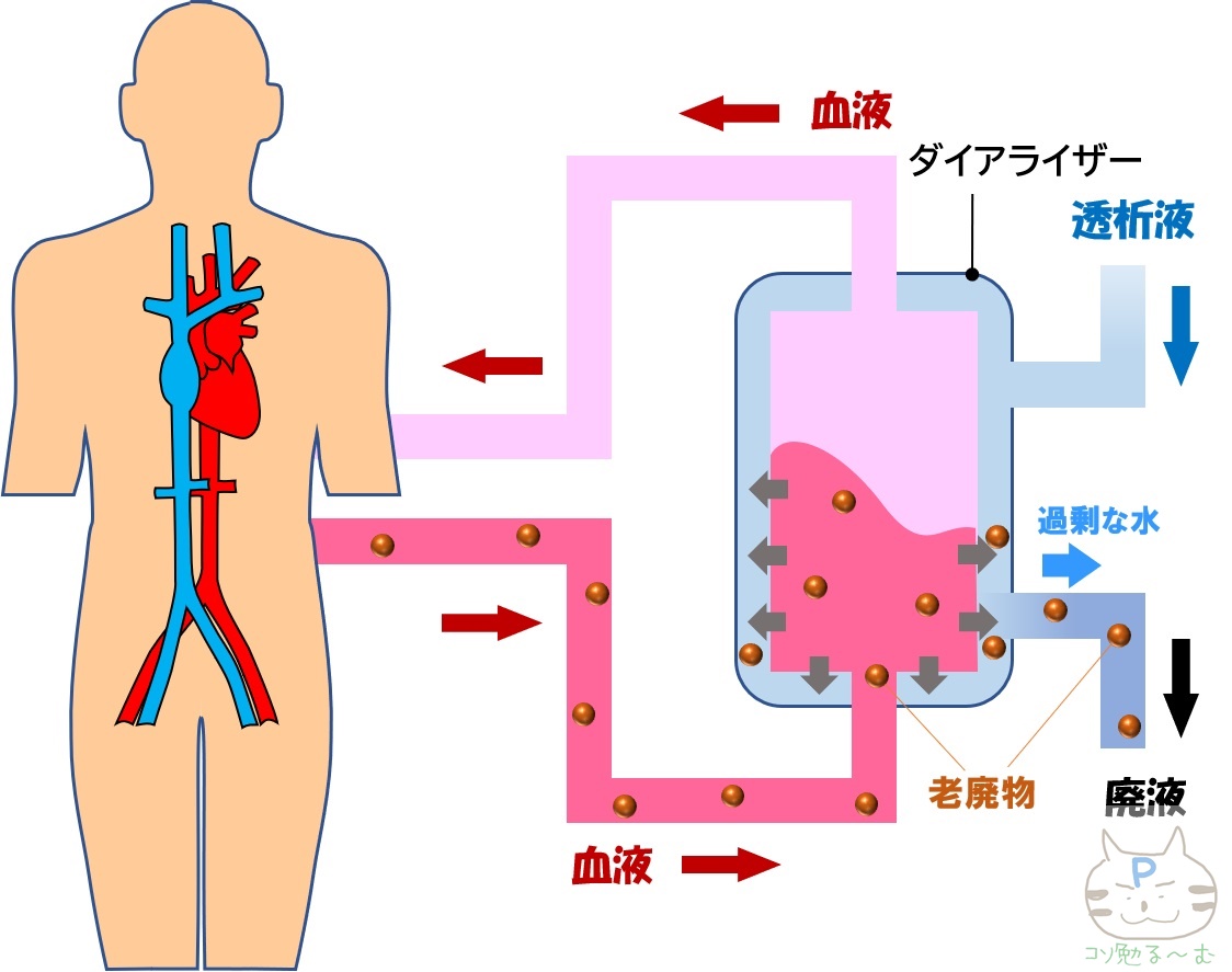 Ecmo Pcpsって何 原理からわかりやすく解説 循環器drぷーのコソ勉る む