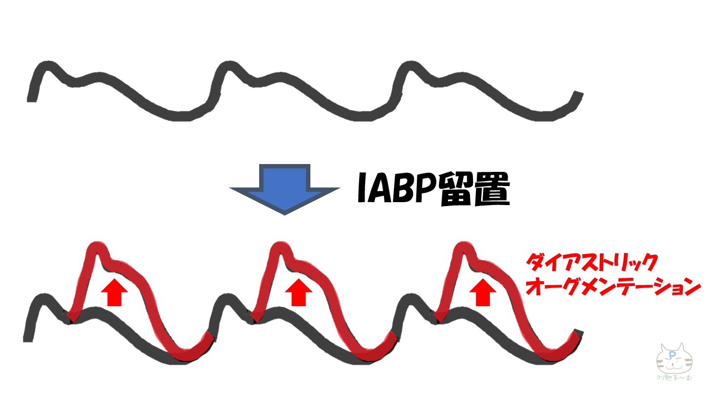 IABP ダイアストリックオーグメンテーション ぷーオリジナル